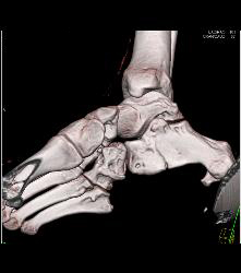 Degenerative Joint Disease (DJD) Foot With Neurofibroma - CTisus CT Scan