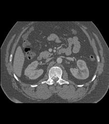 Compression Fracture Abdomen - CTisus CT Scan