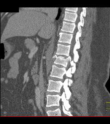 Compression Fracture Abdomen - CTisus CT Scan