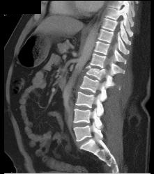 Compression Fracture Abdomen - CTisus CT Scan