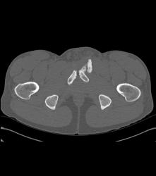 Old Avulsion Injury With Heterotopic Bone - CTisus CT Scan