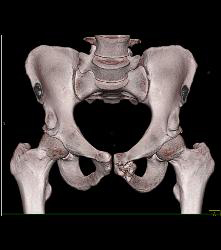 Old Avulsion Injury With Heterotopic Bone - CTisus CT Scan