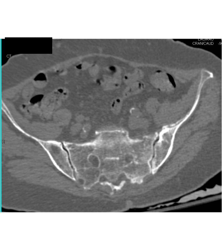 left sided sacral stress fracture - CTisus CT Scan