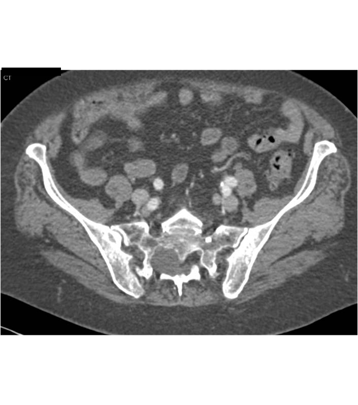 Dural Ectasia - CTisus CT Scan