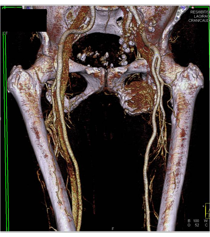 metastatic renal cell carcinoma to symphysis with vascular component - CTisus CT Scan