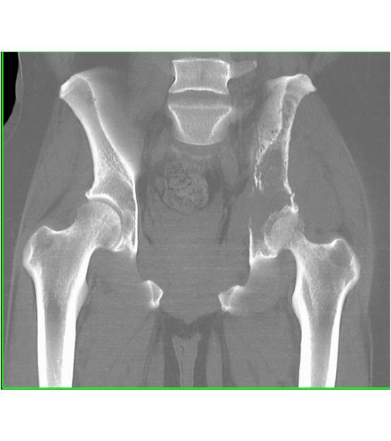 Metastatic Renal Cell Carcinoma - CTisus CT Scan