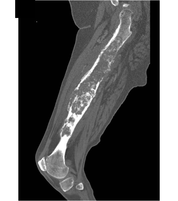 Primary Lymphoma of Bone - CTisus CT Scan