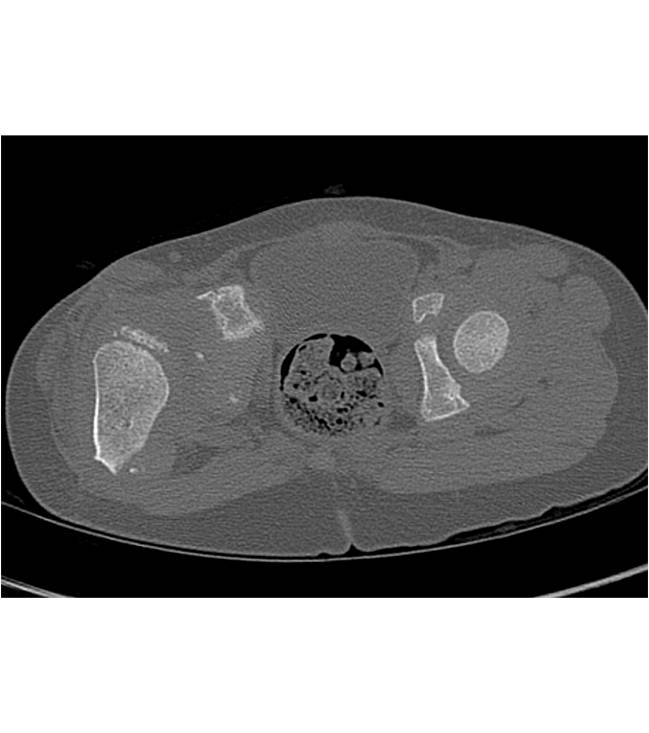 Right Hip Dysplasia with Shallow Acetabulum C/W Congenital Hip Disease - CTisus CT Scan