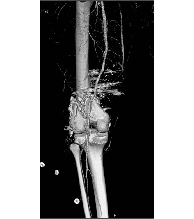 Gun Shot to Femur with Fracture without Vascular Injury Using CT Angiography - CTisus CT Scan