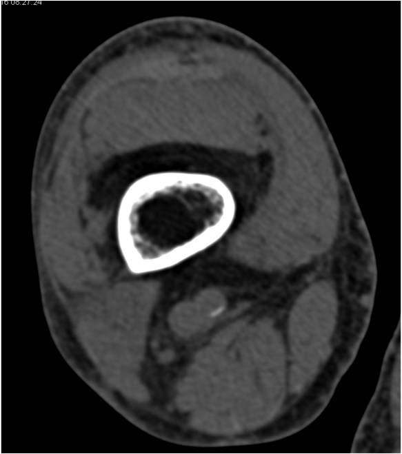 Cystic Erosions off Patella with Soft Tissue Swelling - CTisus CT Scan