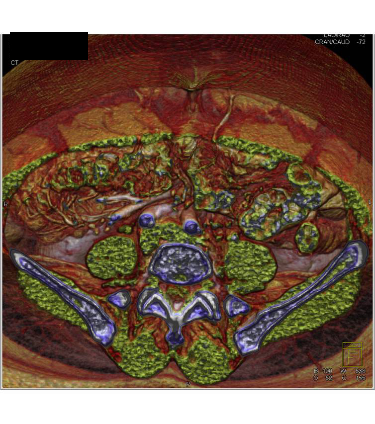 DIEP Flap Planning - CTisus CT Scan