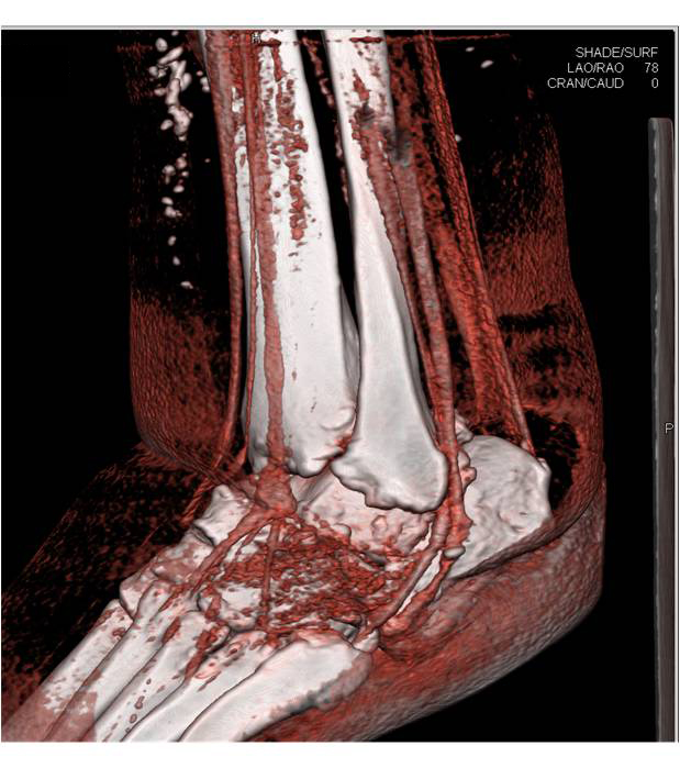 3D Volume Rendering of Tendons Around the Ankle - CTisus CT Scan