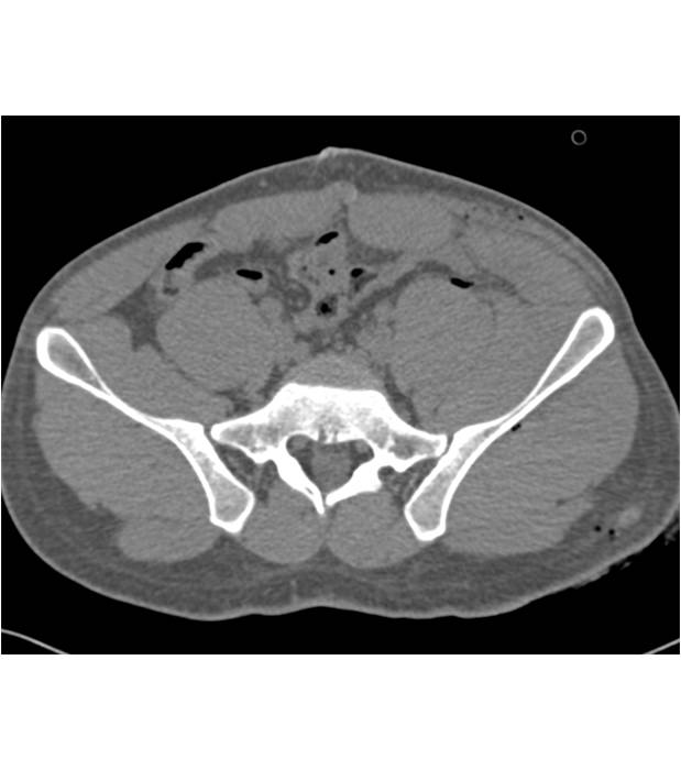 Iliac Fracture due to Gunshot Injury - CTisus CT Scan