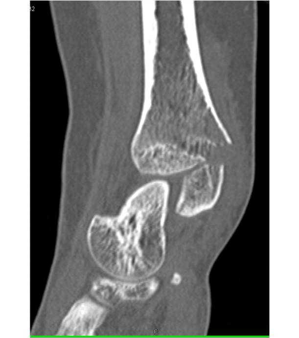 tibial avulsion fracture - CTisus CT Scan