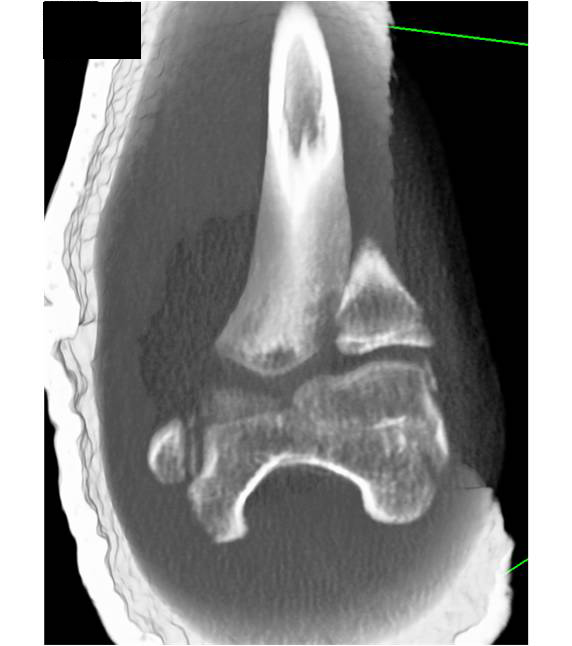 Elbow Trauma with Fractures - CTisus CT Scan