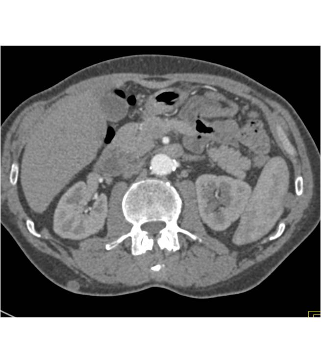 Metastatic Melanoma with Subcutaneous Nodules - CTisus CT Scan