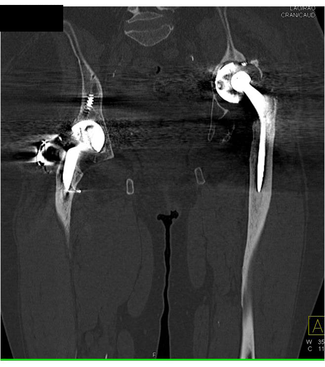 Failed Left Total Hip Replacement - CTisus CT Scan