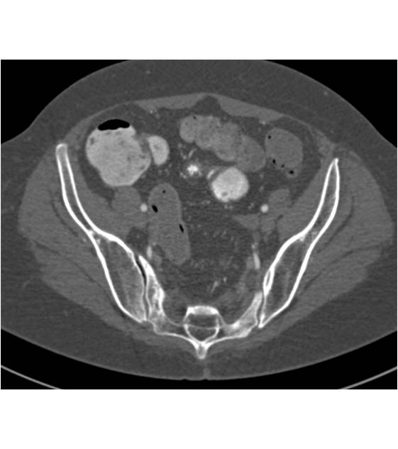 Sacral Stress Fracture - CTisus CT Scan