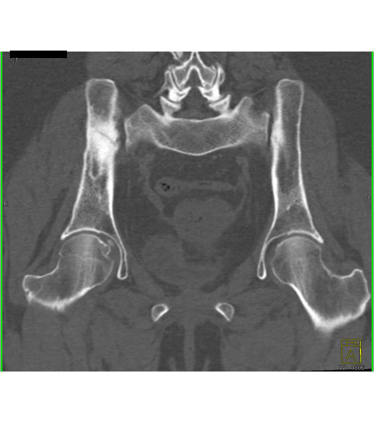 Stress Fracture in Radiated Bone - CTisus CT Scan