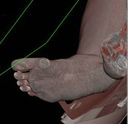 Ulcer Near Base of First Digit - CTisus CT Scan