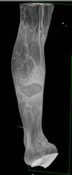 Ulcer Shin with Soft Tissue Swelling with Multiple 3D Renderings - CTisus CT Scan