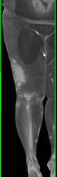 Cellulitis Thigh with Multiple 3D Presentations - CTisus CT Scan