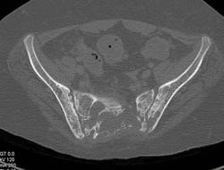 Plasmacytoma of the Sacrum - CTisus CT Scan