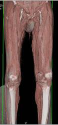 Metastatic Renal Cell Carcinoma with 3D Map - CTisus CT Scan