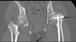 SCFE (Slipped capital Femoral Epiphysis) with Pinning and Failiure to Prevent Slippage - CTisus CT Scan