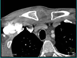 Infected Sternoclavicular Joint with Bone Changes C/W Early Osteomyelitis - CTisus CT Scan