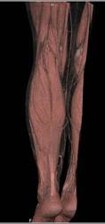 Soft Tissue Induration Upper Calf with 3D VRT Modeling of Muscle - CTisus CT Scan
