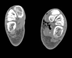 Gas Gangrene of the Foot with Tissue Necrosis - CTisus CT Scan