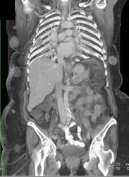 Metastatic Melanoma to Muscle, Nodes, Abdominal Wall - CTisus CT Scan