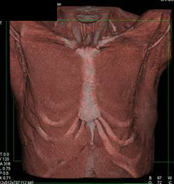 Chest Wall Deformity - CTisus CT Scan