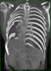 3D Mapping of Chest Wall Deformity - CTisus CT Scan