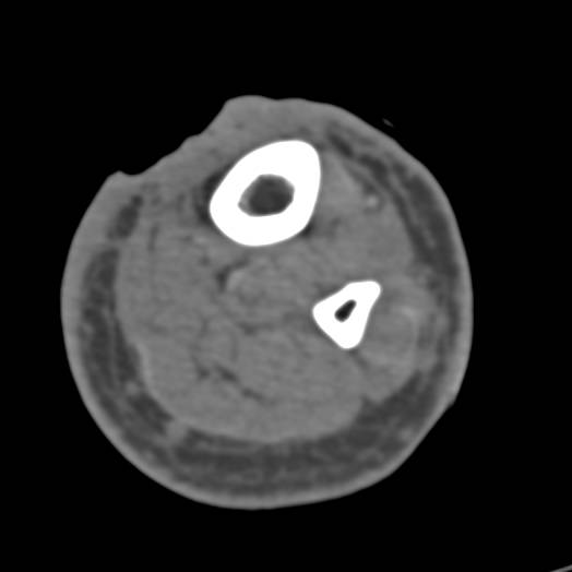 Ulceration Skin with Cellulitis with Nice 3D VRT Views - CTisus CT Scan