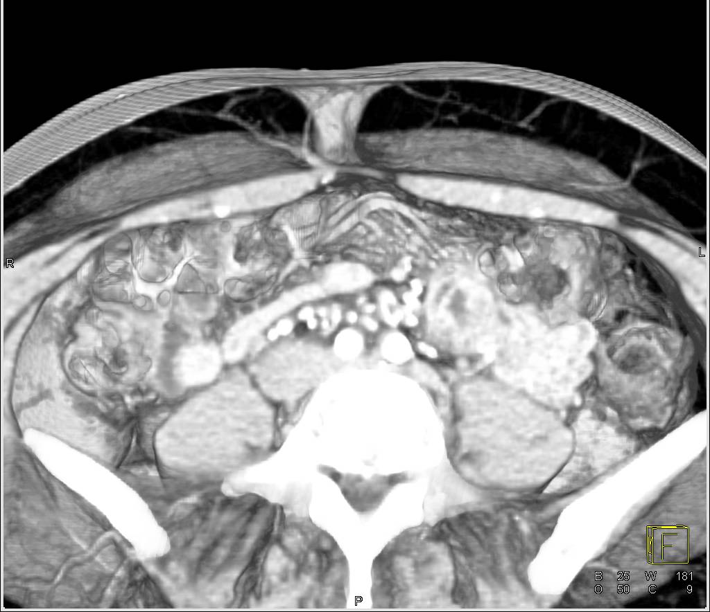 3D of DIEP Flap Planning - CTisus CT Scan