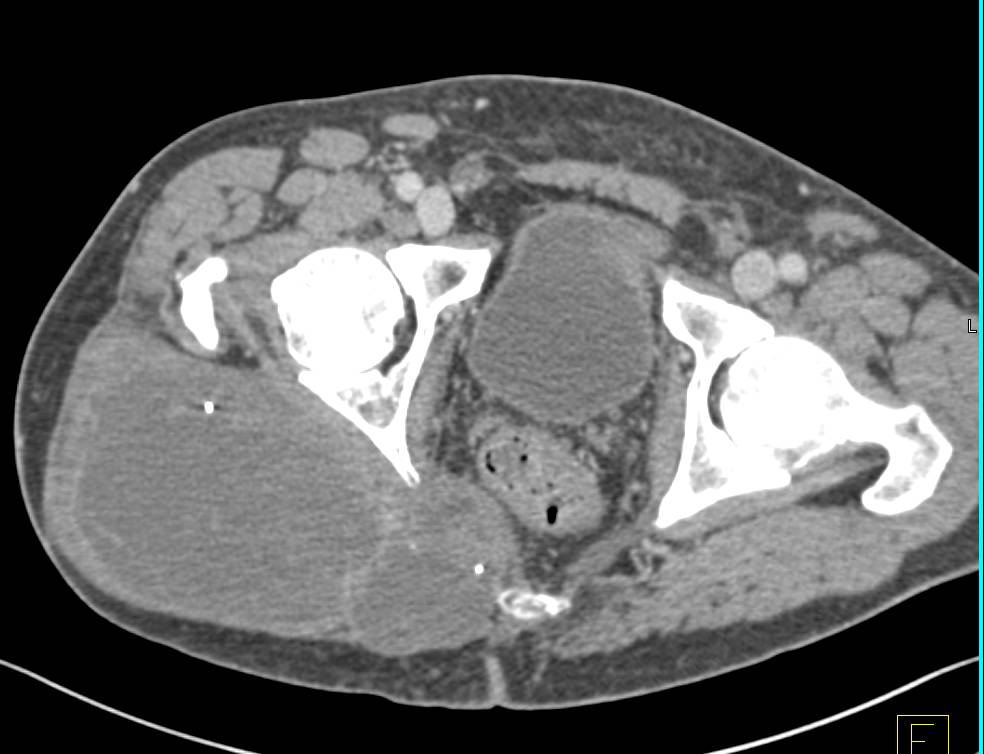 Neurogenic Sarcoma Right Thigh - CTisus CT Scan