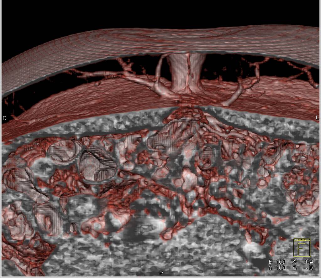 DIEP Flap Planning for Reconstructive Breast Surgery - CTisus CT Scan