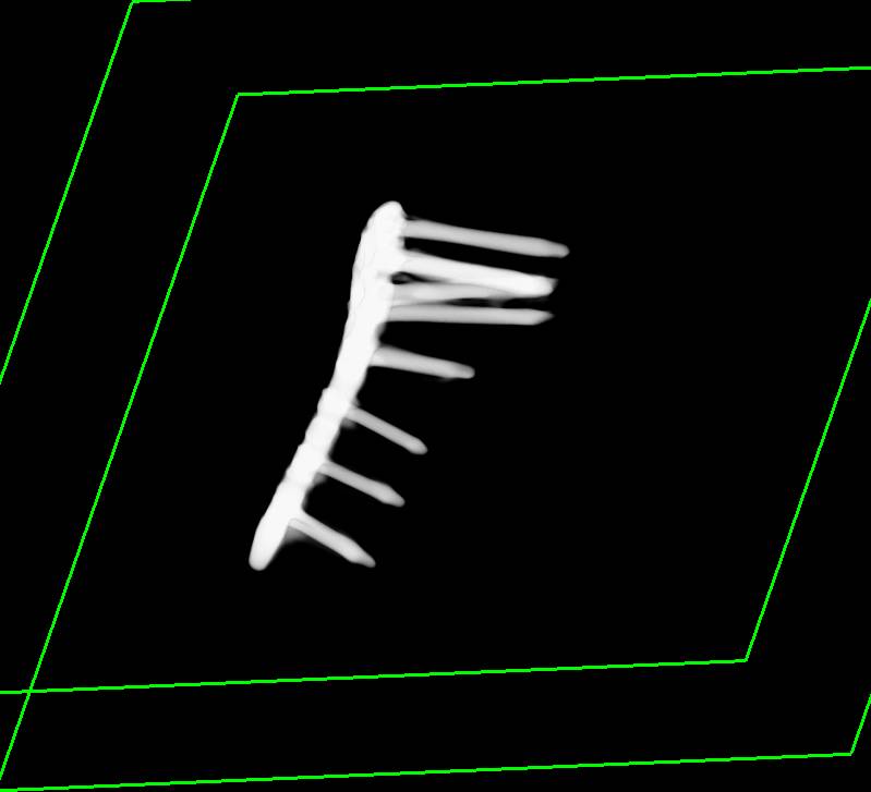 Repair of Humerus Fracture with Hardware in Place - CTisus CT Scan