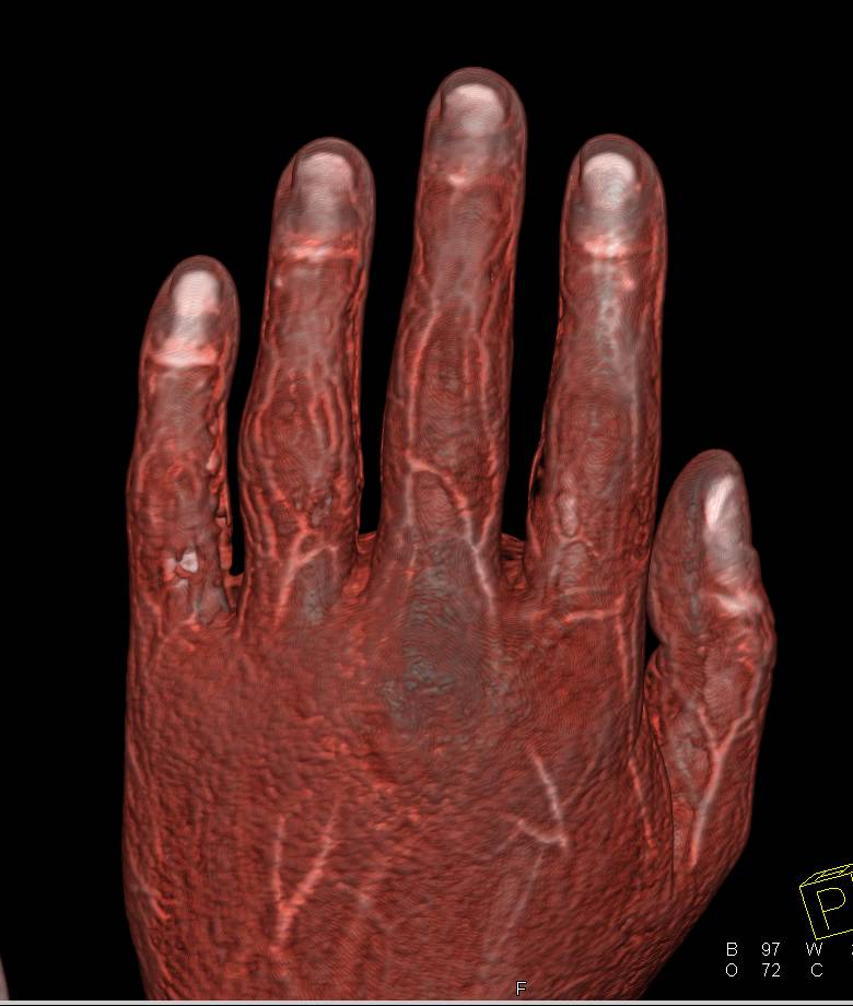 CTA of the Arm and Hand with Various Rendering Techniques Including Bone Removal - CTisus CT Scan