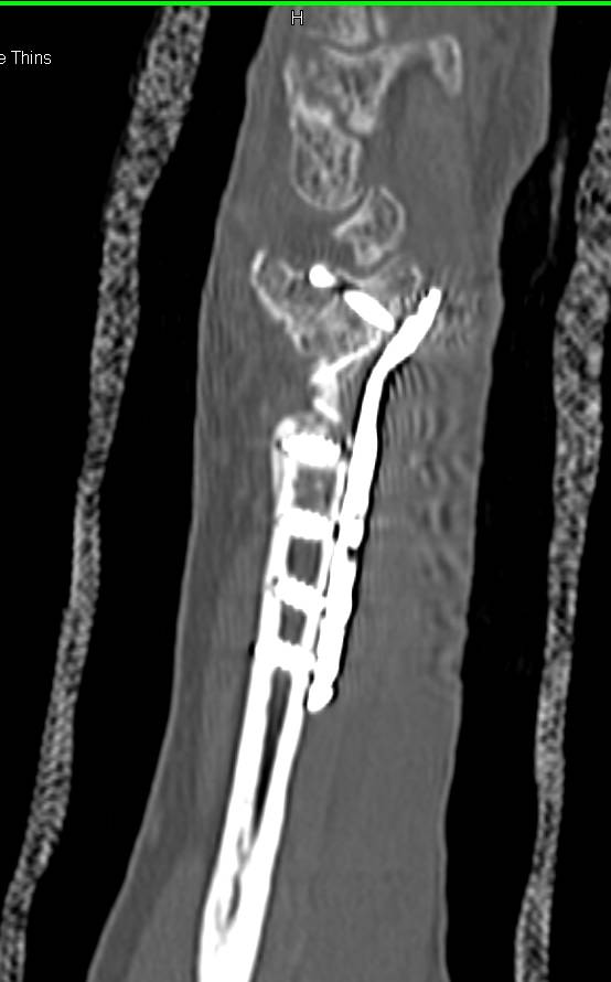 Nonunion of a Distal Radius Fracture with Hardware - CTisus CT Scan