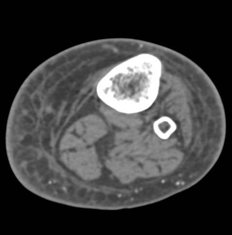 Induration of the Lower Leg with 