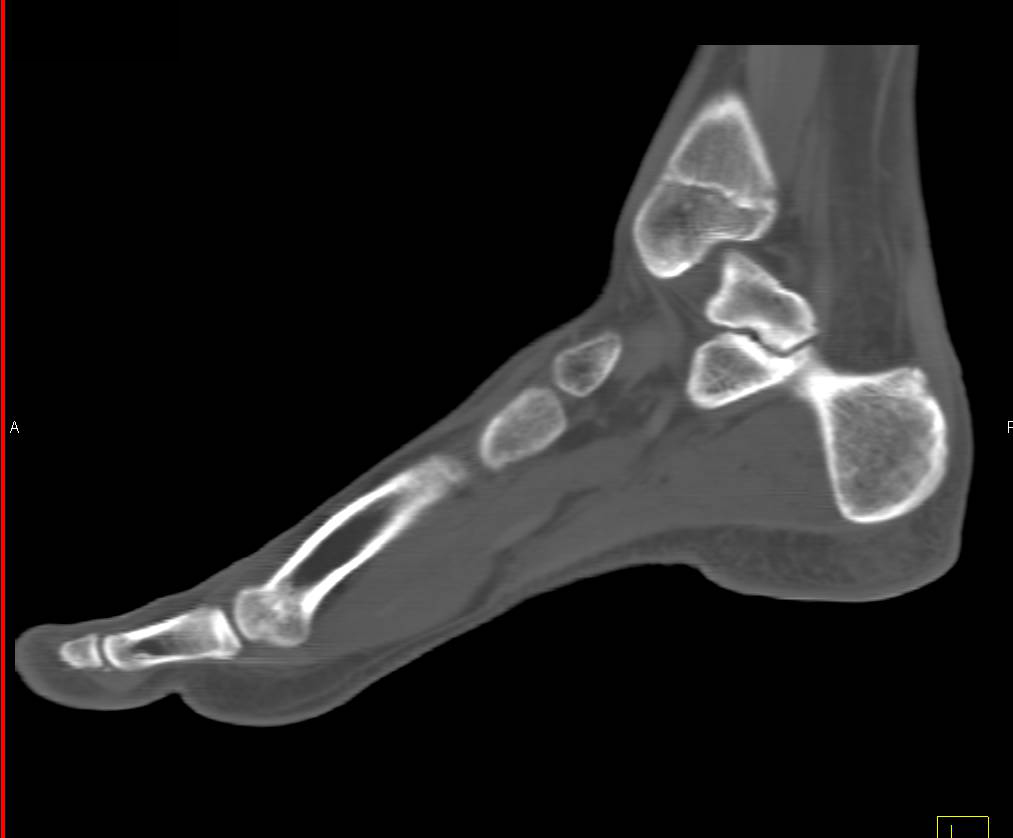 Fibrous Tarsal Coalition - CTisus CT Scan