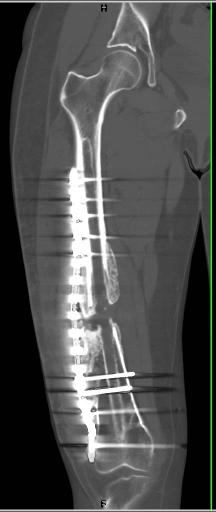 Nonunion of the Femur Across a Prior Fracture Site with Hardware in Place - CTisus CT Scan