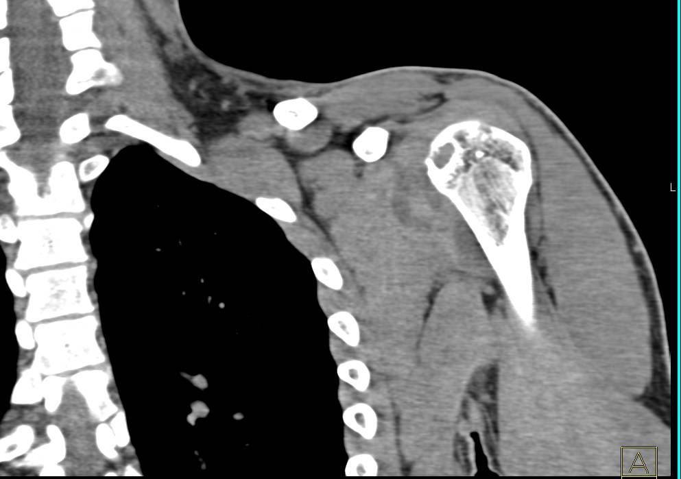 Cystic Degenerative Change and Joint Effusion - CTisus CT Scan