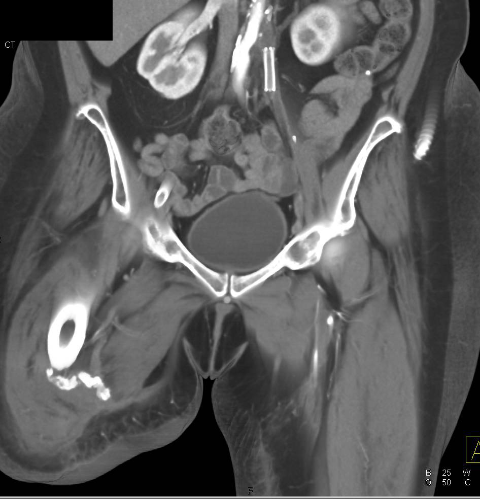 Ulceration Inner Right Thigh with Several 3D Rendering Techniques - CTisus CT Scan