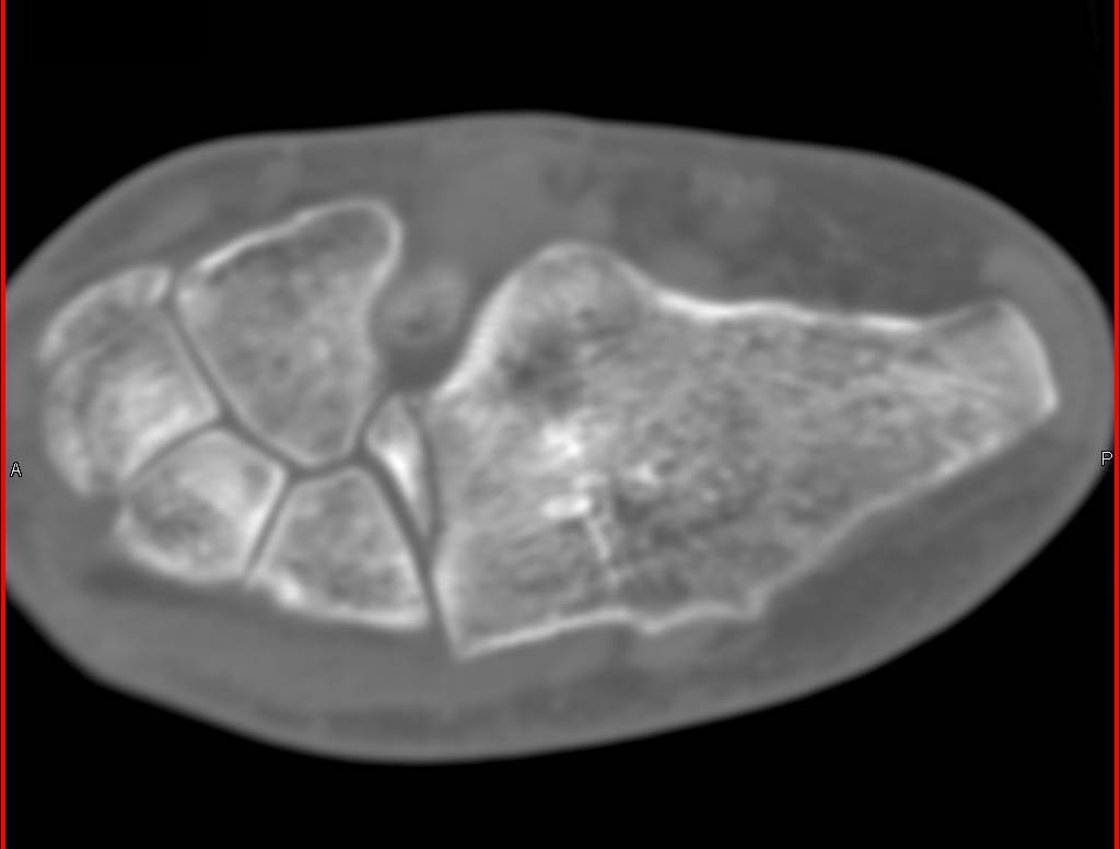 Calcaneal Fracture with Standard and High Resolution Bone Images - CTisus CT Scan
