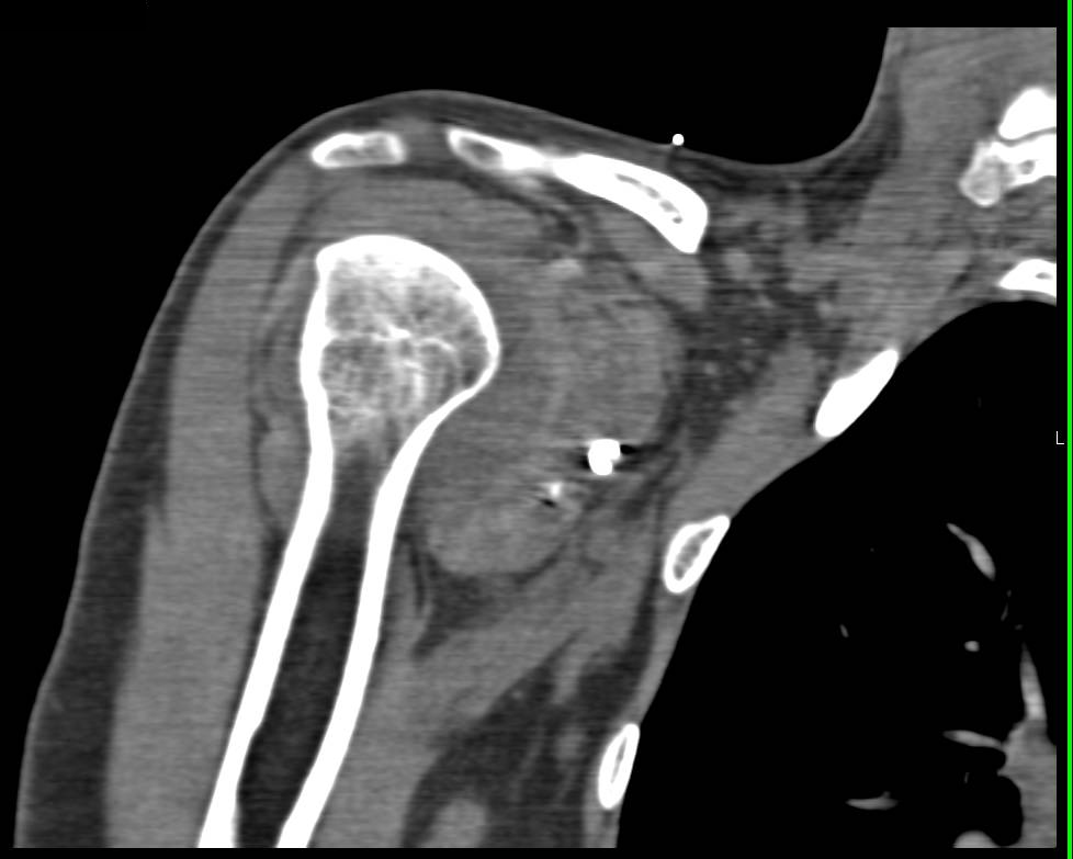 Prior Shoulder Surgery with Fractures of the Pins in the Scapula - CTisus CT Scan