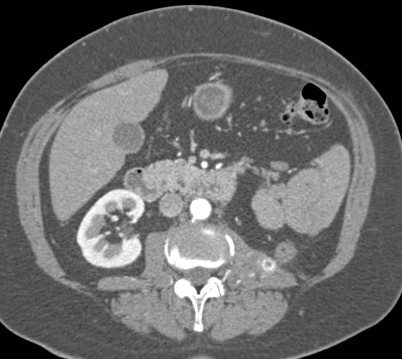 Metastatic Renal Cell Carcinoma to the Left Psoas Muscle - CTisus CT Scan